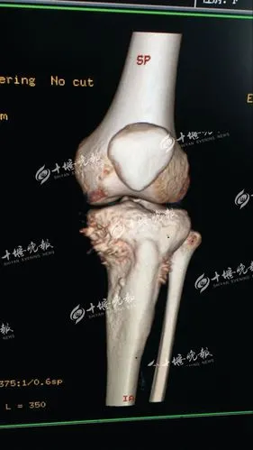 小王左胫骨上段骨肉瘤的ct片.