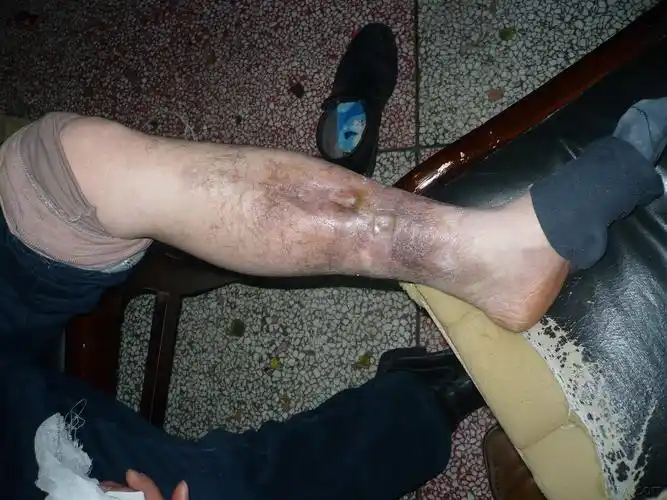 这一例胫骨慢性骨髓炎大家有啥好建议