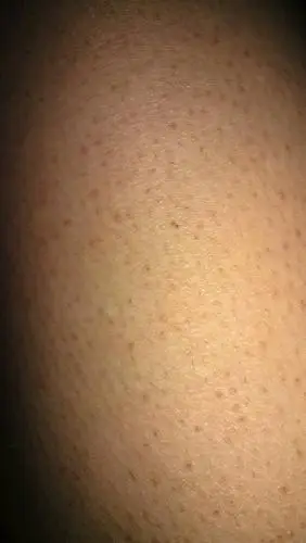 腿上好多毛孔不长毛,形成好多点,很难看不敢穿短裤