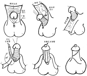 形状如女性,不能站立排尿,龟头背侧包皮如围裙状,阴茎腹侧无包皮系带
