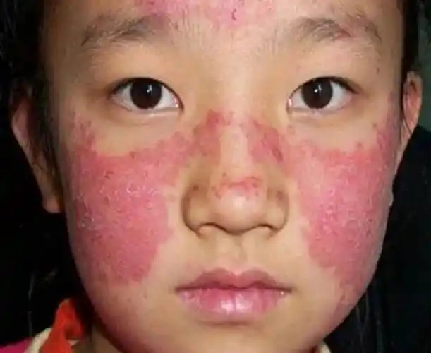 "红斑狼疮"冲上热搜,高发人群是年轻女性?中医这么说