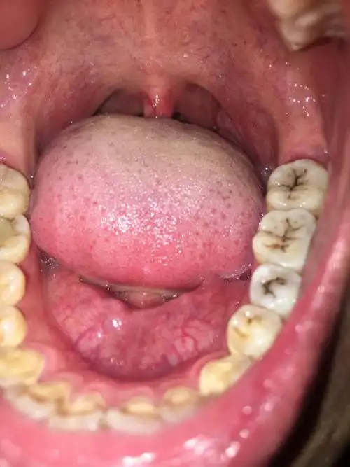 我的喉咙是长息肉了吗 严重吗?感觉喉咙总有异物感,吃什么都吐