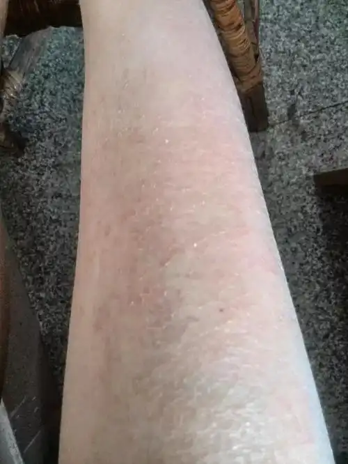 冬天小腿干燥.红红的,擦身体乳也没用