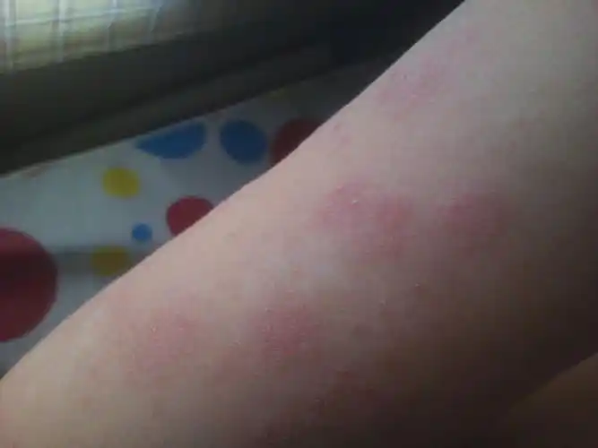 我胳膊上不知道长的些什么东西,某一块一块的,不