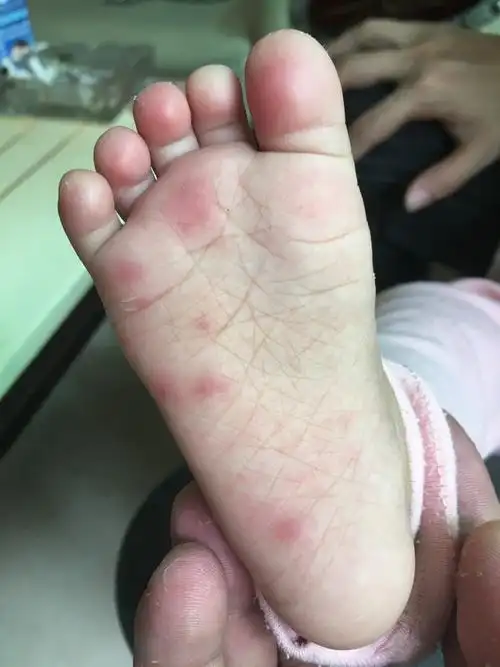 宝宝,女,六个月了 昨天右脚脚心出现红点,左脚没有 因为前天低烧,有在