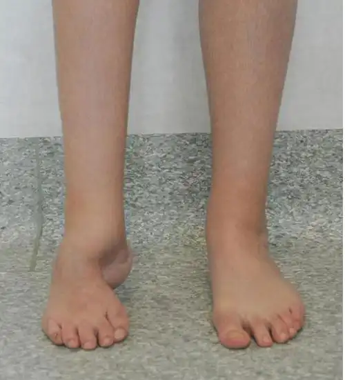 马蹄内翻足畸形的治疗 - 好大夫在线