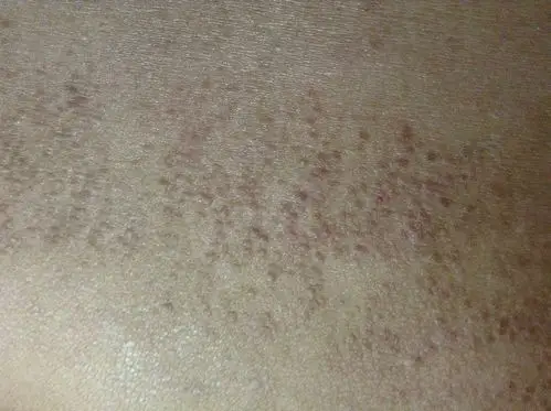 艾滋病皮肤症状图片,这些太明显了