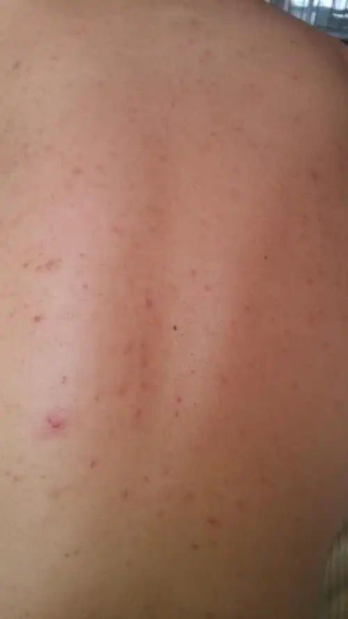 背部有几年了 以前也没怎么注意 现在有点严重 平时也比较痒 也去过