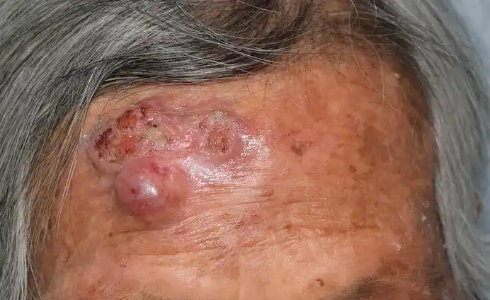 浙大二院提醒皮肤上长了 "小疙瘩",一查竟已癌变?注意了!