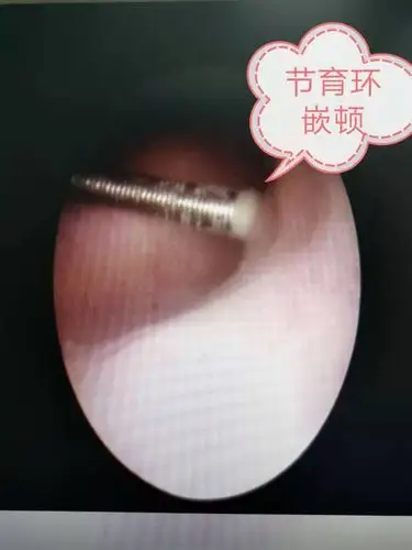 我院宫腔镜下取出嵌顿的或者残留的节育环.