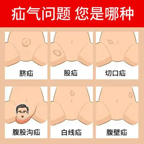 【买1发2,买2发5】南京同仁堂绿金家园 疝气保健贴 6贴 腹股沟斜疝