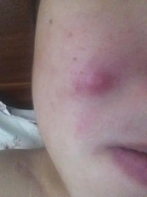 最近脸上起这样的大脓包很疼,怎么办啊.用什么药啊?