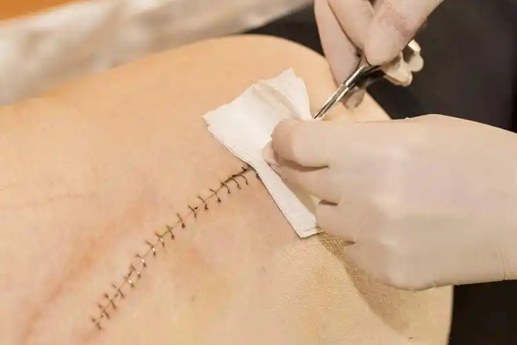 伤口缝合方法五花八门到底哪种最适合你
