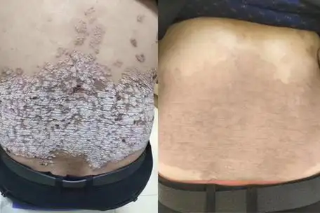 牛皮癣1招断根李院长治疗大揭秘