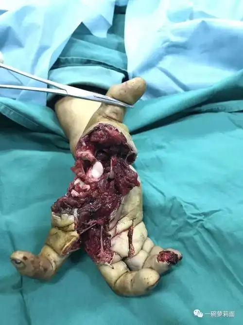 手受伤了缝起来不就好了可没那么简单