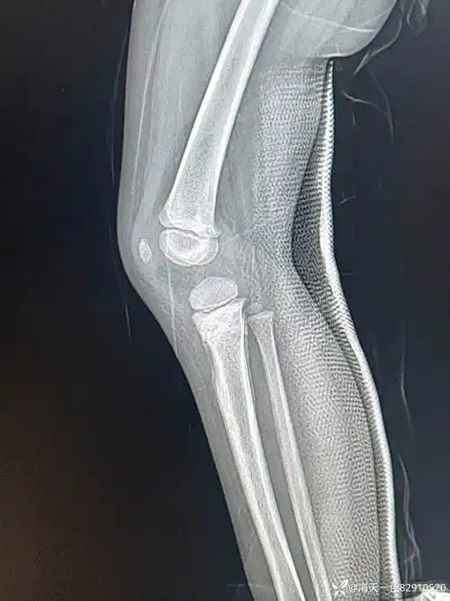 儿童胫骨近端骨折