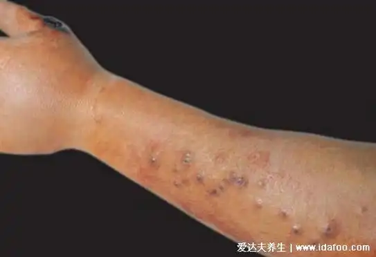 皮肤炭疽病的症状图片,红斑发展成水疱坏死形成溃疡黑痂