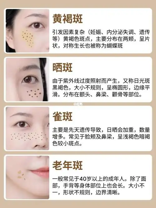 色斑类型自测想要淡斑先搞清楚你是哪种斑