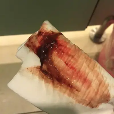 怀孕后突然流血 见图 请问是自然流产吗 图片是孕囊流出来了吗