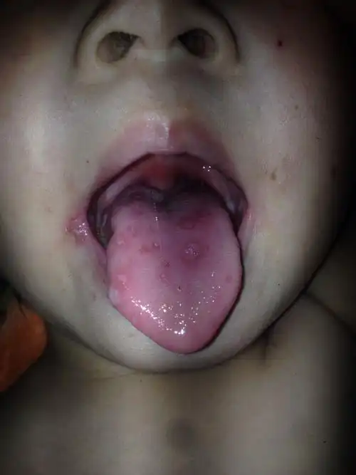 小儿手足口病舌头图片_有来医生