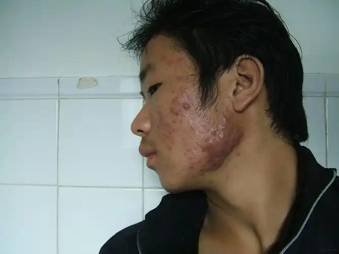 这样的青春痘怎么治疗? - 皮肤及性传播疾病讨论版 - 爱爱医医学论坛