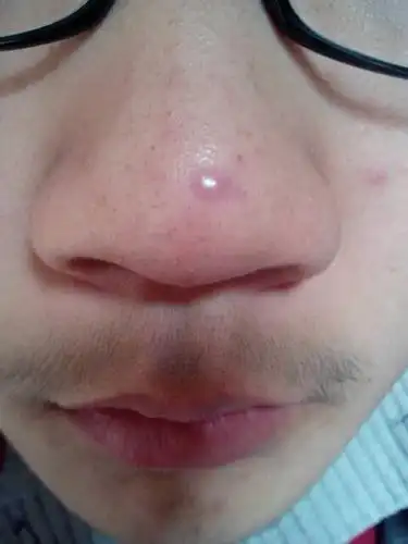 我鼻子上长了个紫红色的包,2个月了.该怎么治?