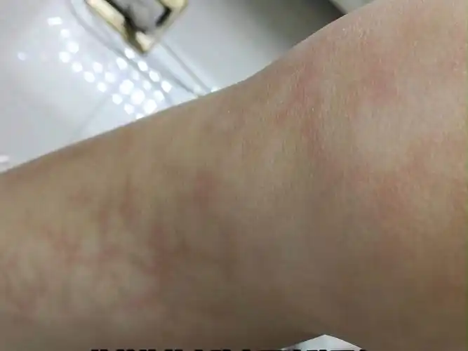 原来这是把自己烤熟了啊 #烤火斑 #冬天 #冷知识