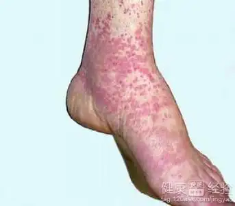 血管炎算重大疾病吗 血管炎是大病吗