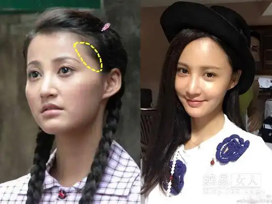 张歆艺之前的额头瘪瘪的,看起来很窄,太阳穴也有些凹陷.