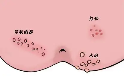 肛门带状疱疹图片