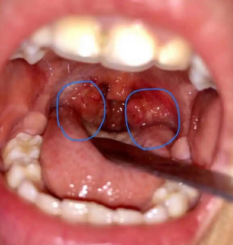 宝宝扁桃体肥大居家自测指南 俗话说得好,有图才有真相,关于扁桃体