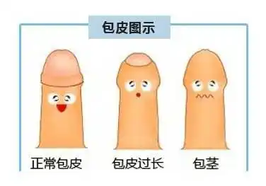 5,包茎的人,包皮上翻露出龟头后,容易形成狭窄环,如操作不当可引起