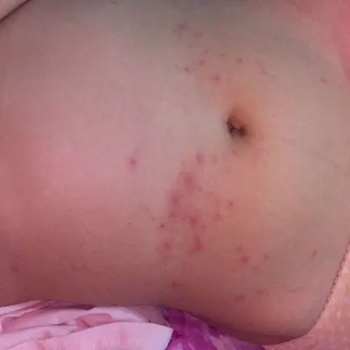 肚子上长了好多这样的痘痘是为什么呀 有点痒.很痛.