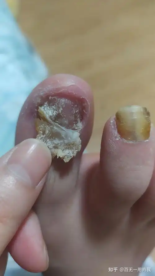 消灭严重灰指甲夏天穿鞋美美哒