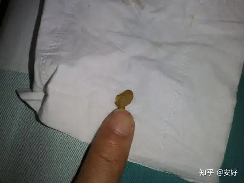 本人26岁痔疮手术经历体会