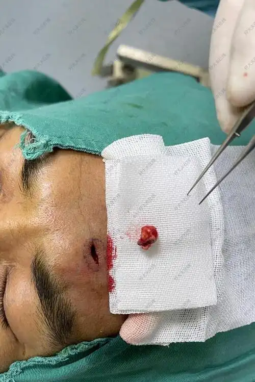 额部皮脂腺囊肿_皮脂腺囊肿 - 好大夫在线