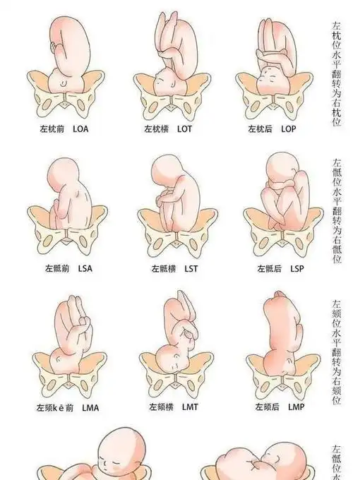 头位:就是枕先露,也就是胎儿的头朝下屁股朝上,这种胎位最适合顺产