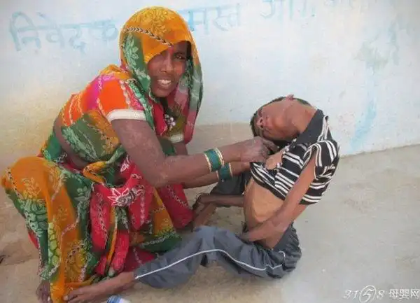 患罕见怪病的印度男孩 脖子弯折头部倒垂