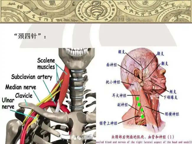 颈四针加郑氏四步手法治疗神经根型颈椎病