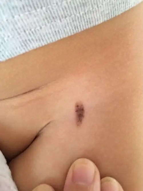 黑色素瘤,我女儿出生就有一个痣,现在长大了,是黑色素瘤吗?求助!急求!