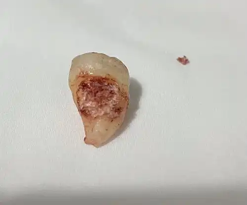 拔了智齿,但根部这个东西是啥有人知道吗?
