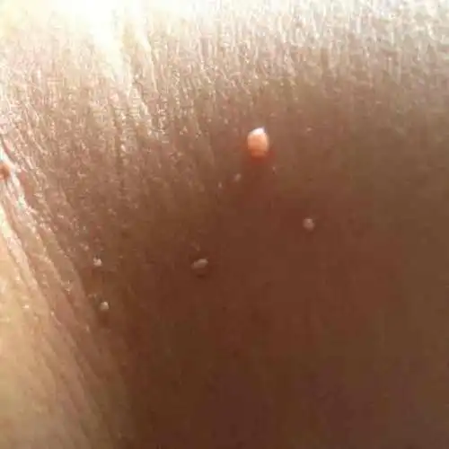 皮肤上长的小肉疙瘩是什么