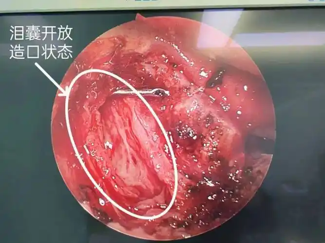 神奇!眼科疾患,竟然从鼻腔解决_手术_治疗_进行