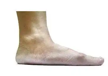 扁平足如何判断?