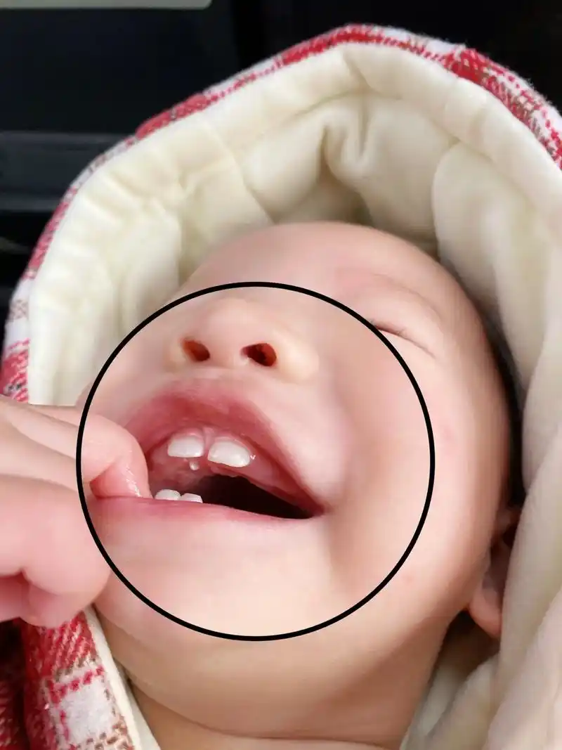 十个月宝宝口腔上颚长了一颗牙.