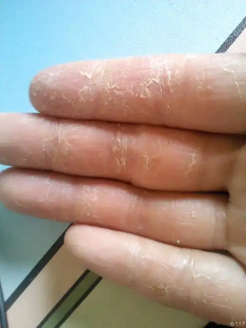 本人神经科医生却不小手得了手癣求治疗