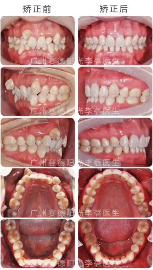 牙齿重度拥挤 | 虎牙男孩矫正记