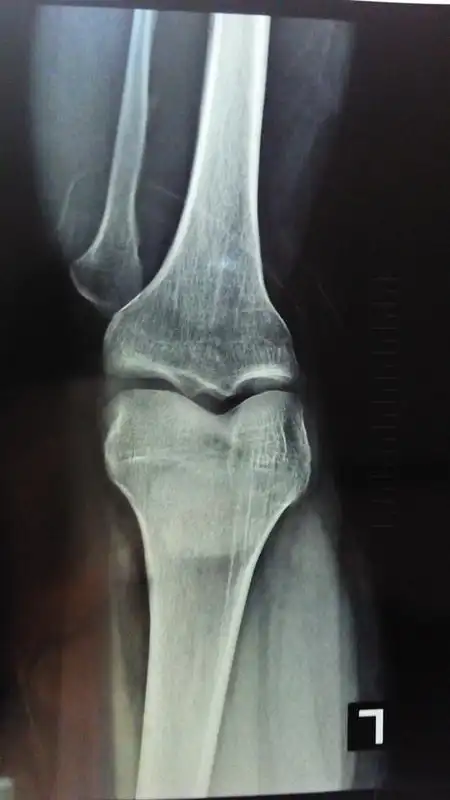 请您帮我看下我的骨骺线闭合了没有,还有长高的希望吗?