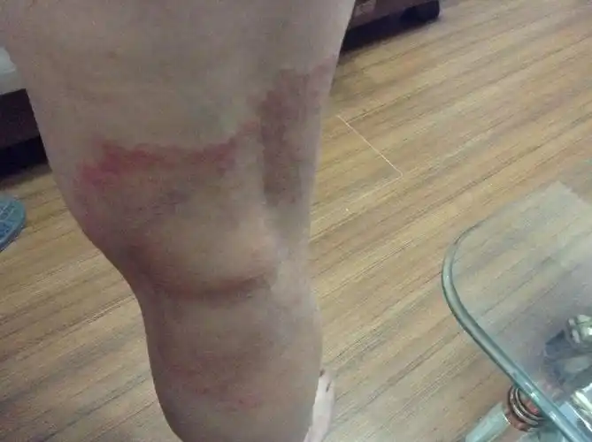 腿部有一片发红,有疙瘩,发痒.