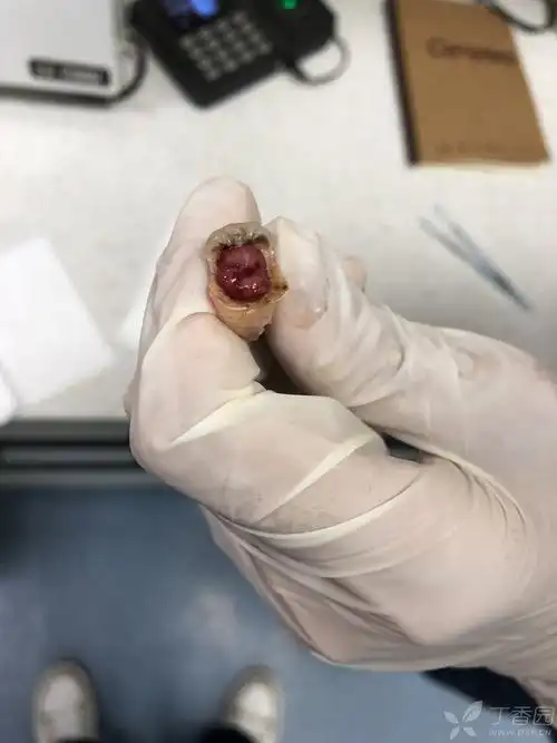 智齿牙髓息肉 - 口腔专业讨论版 -丁香园论坛